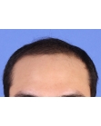 Before Hair Transplant &nbsp;Front